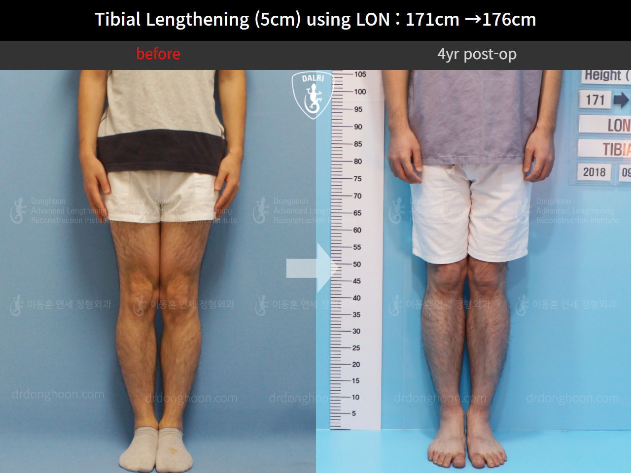 Before and after cll lon, case 4323445, image 3, Dr. Donghoon institute (DALRI)
