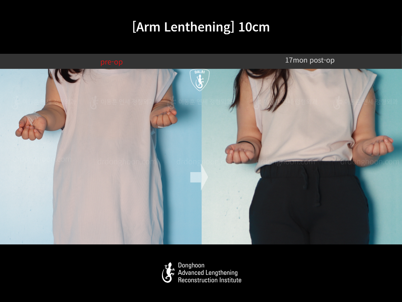 Before and after arm lengthening, case 17924395, image 2, Dr. Donghoon institute (DALRI)
