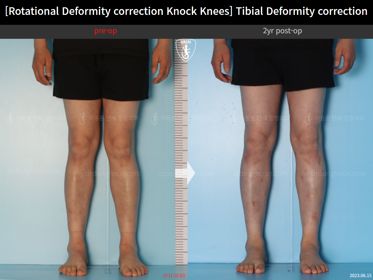 Before and after adult knock knees, case 15524370, image 6, Dr. Donghoon institute (DALRI)
