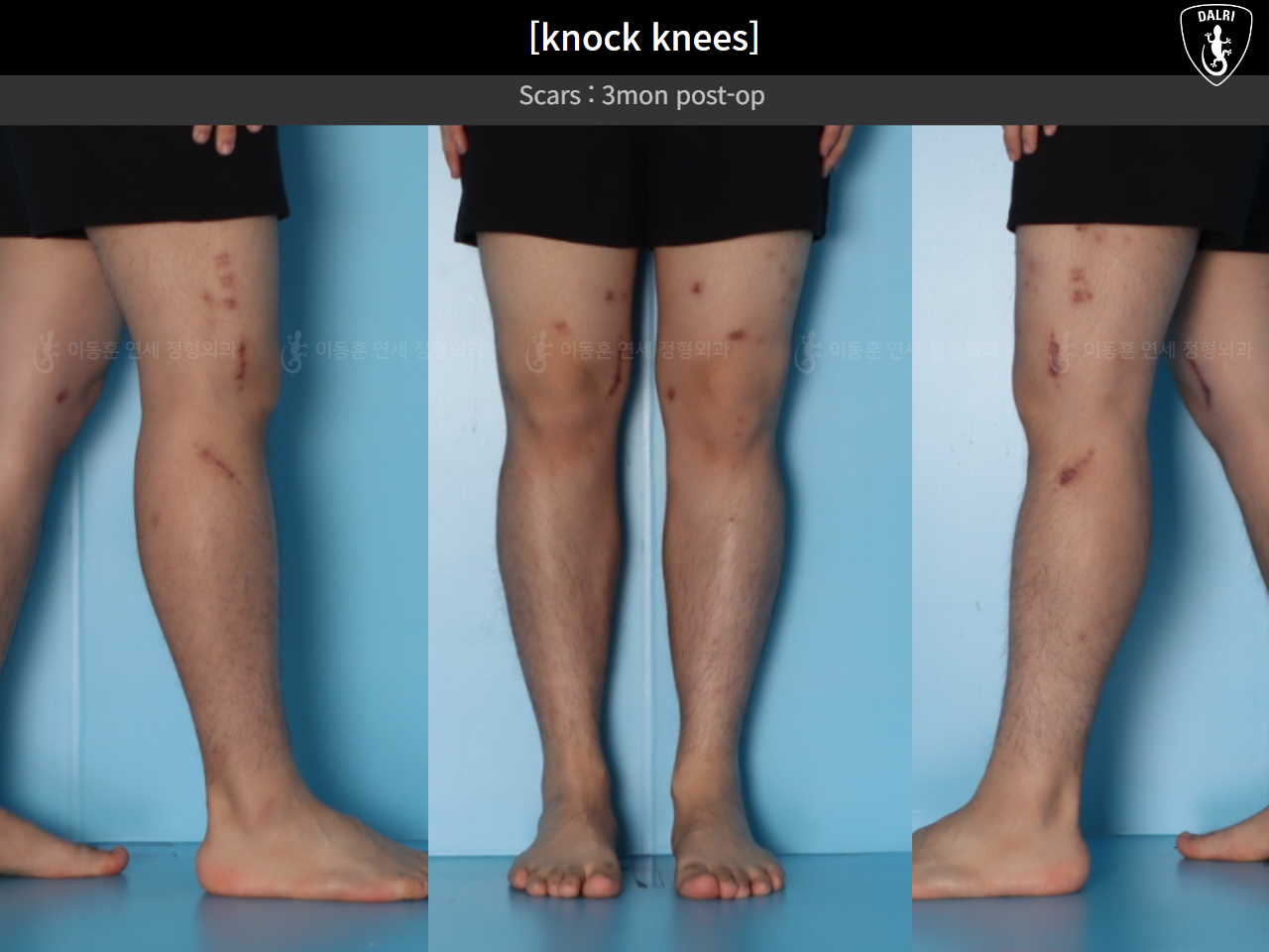 Before and after adult knock knees, case 124642361, image 9, Dr. Donghoon institute (DALRI)