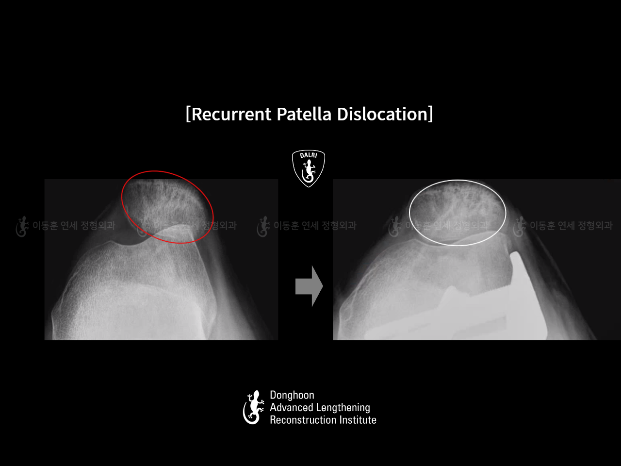 Before and after adult bowlegs, case 18088212, image 10, Dr. Donghoon institute (DALRI)
