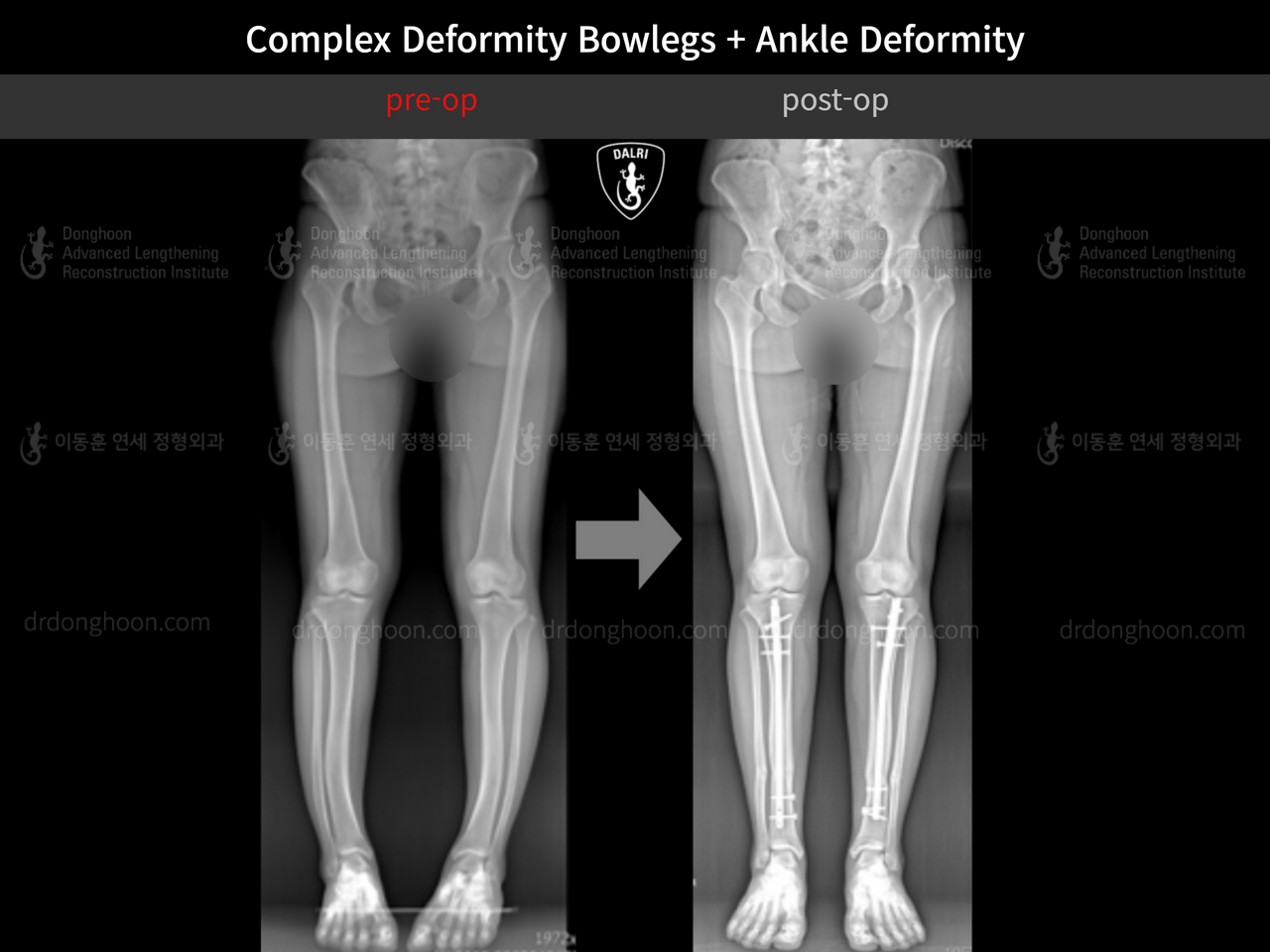 Before and after foot & ankle deformity, case 13215063, image 3, Dr. Donghoon institute (DALRI)