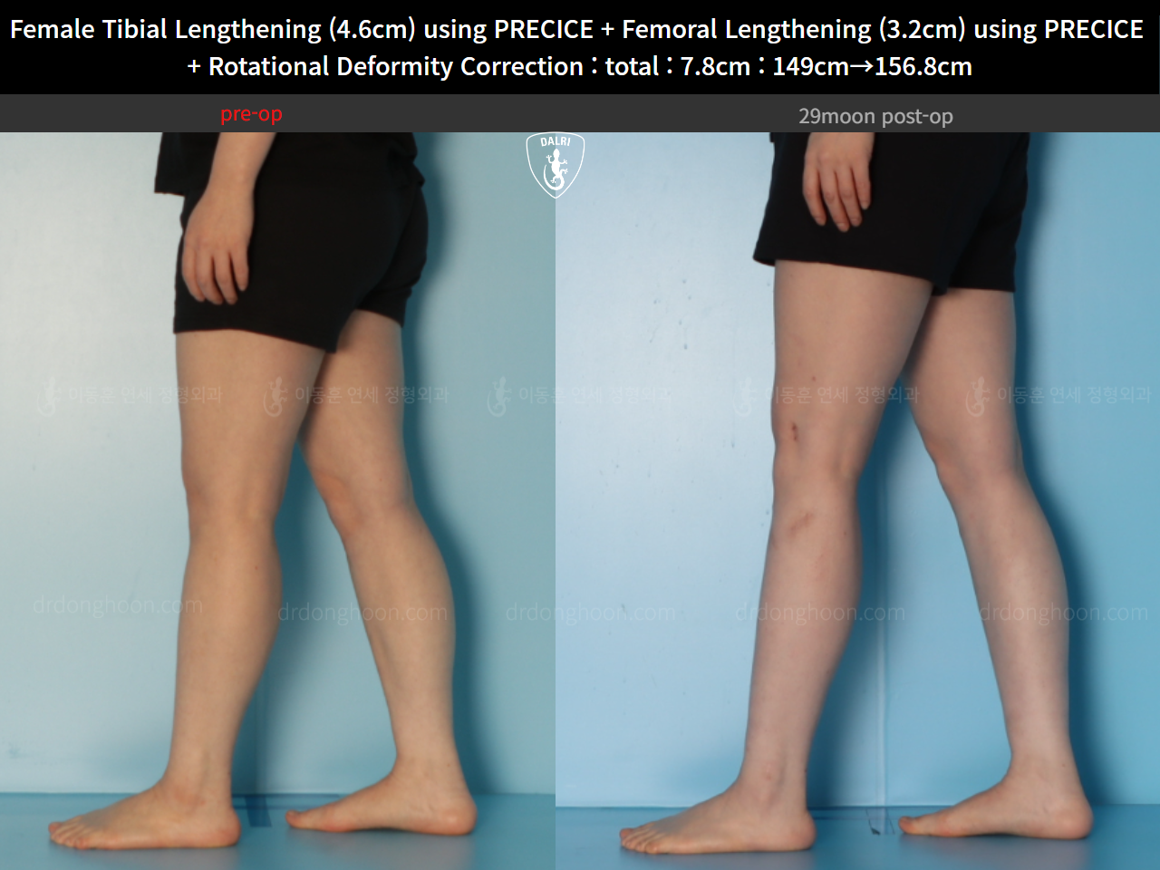 Before and after cll precice, case 123686647, image 11, Dr. Donghoon institute (DALRI)