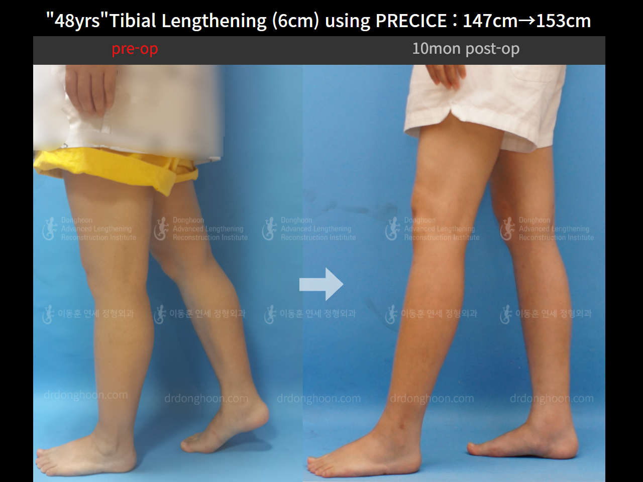 Before and after cll precice, case 4323403, image 3, Dr. Donghoon institute (DALRI)