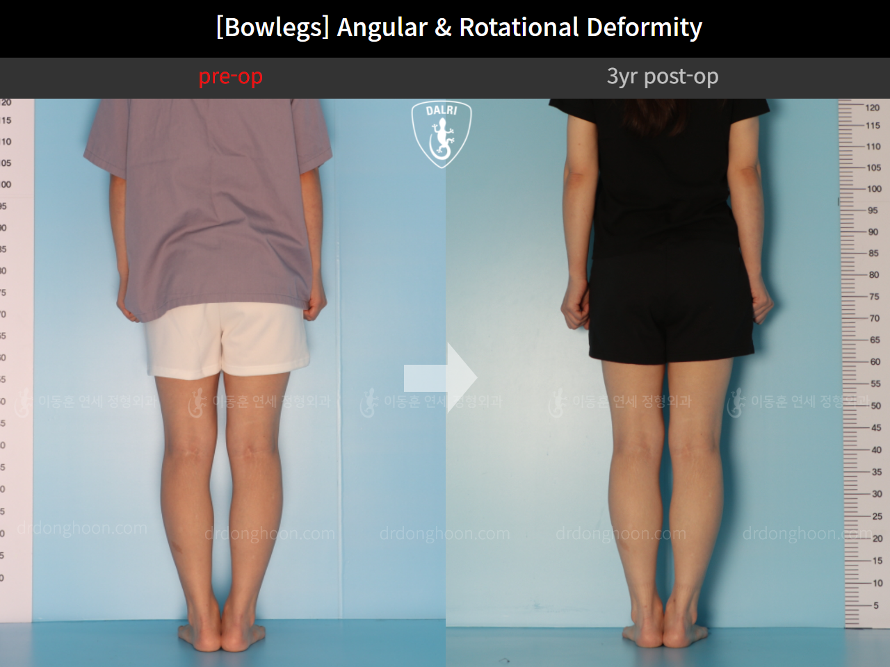Before and after adult bowlegs, case 9678047, image 6, Dr. Donghoon institute (DALRI)