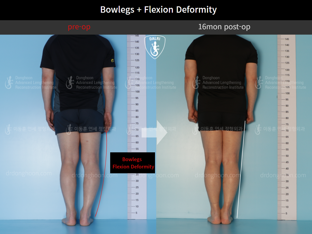 Before and after adult bowlegs, case 10451182, image 2, Dr. Donghoon institute (DALRI)
