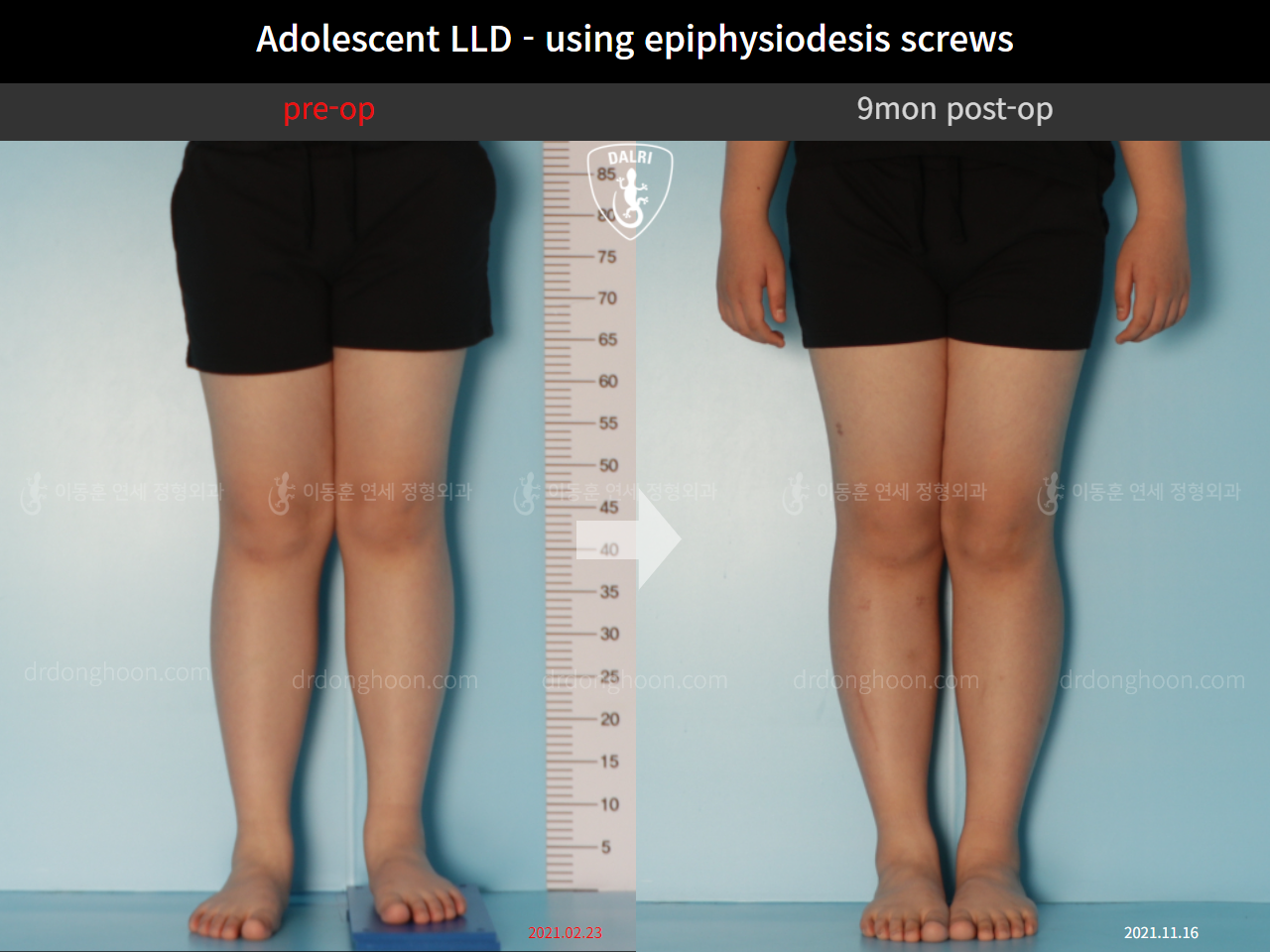 Before and after paediatric & adolescent lld, case 10470781, image 4, Dr. Donghoon institute (DALRI)