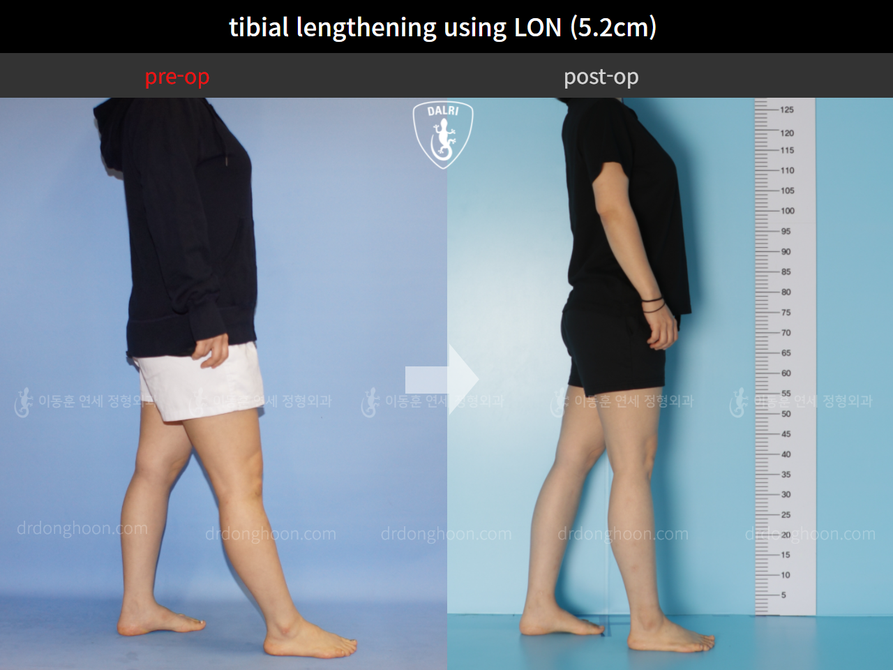 Before and after cll lon, case 4860933, image 3, Dr. Donghoon institute (DALRI)