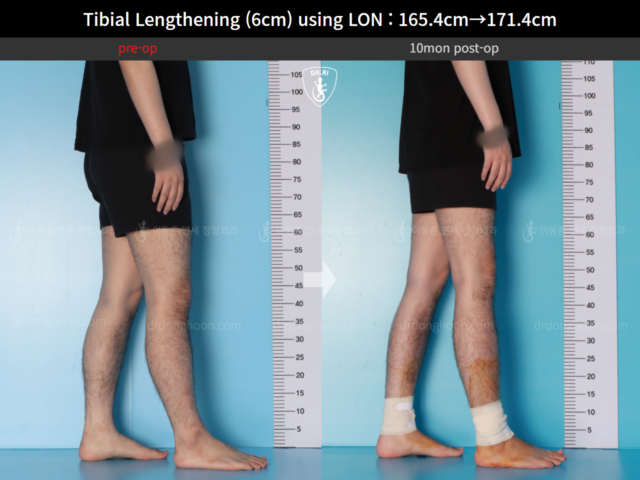 Before and after cll lon, case 15716525, image 12, Dr. Donghoon institute (DALRI)