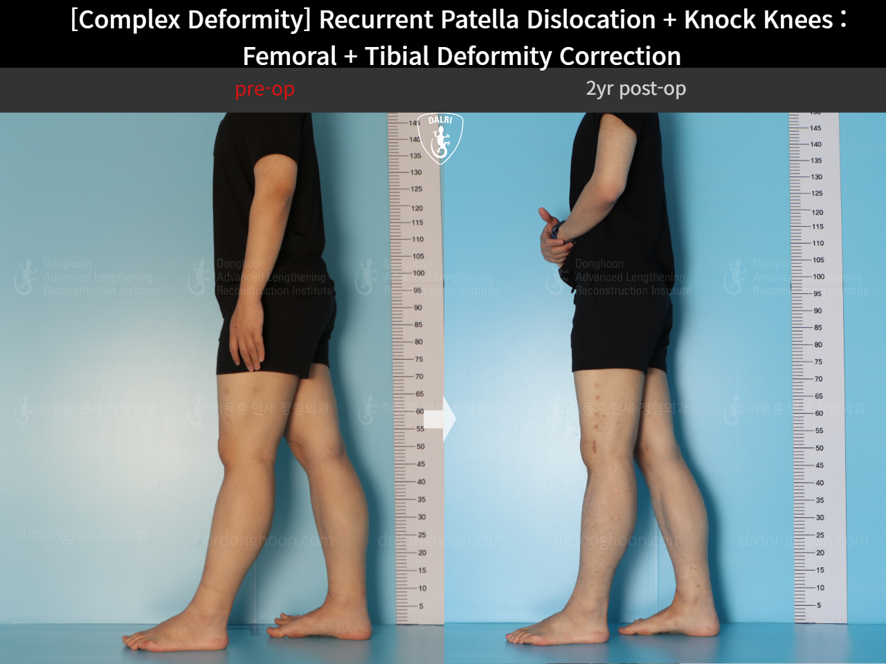 Before and after complex deformity, case 17435051, image 3, Dr. Donghoon institute (DALRI)
