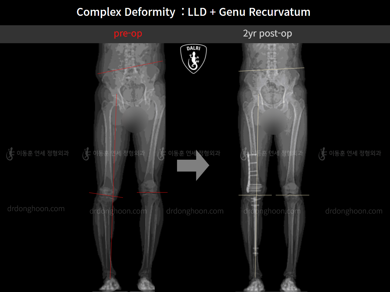 Before and after adult lld, case 11313494, image 3, Dr. Donghoon institute (DALRI)