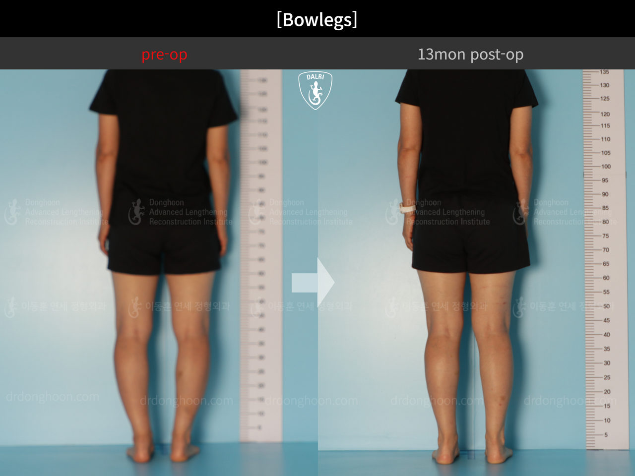 Before and after adult bowlegs, case 13223508, image 6, Dr. Donghoon institute (DALRI)