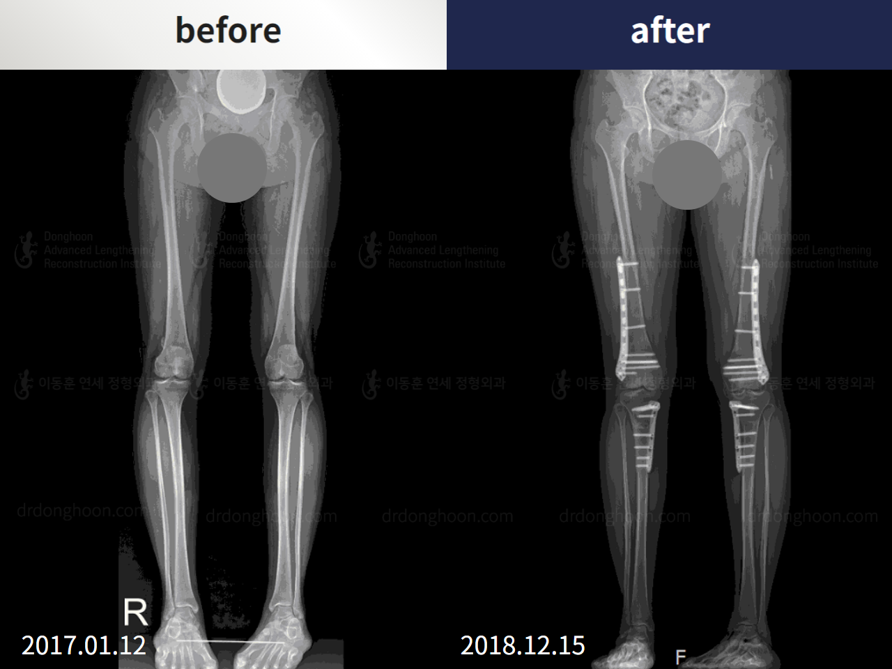 Before and after recurrent patella dislocation, case 4594087, image 2, Dr. Donghoon institute (DALRI)