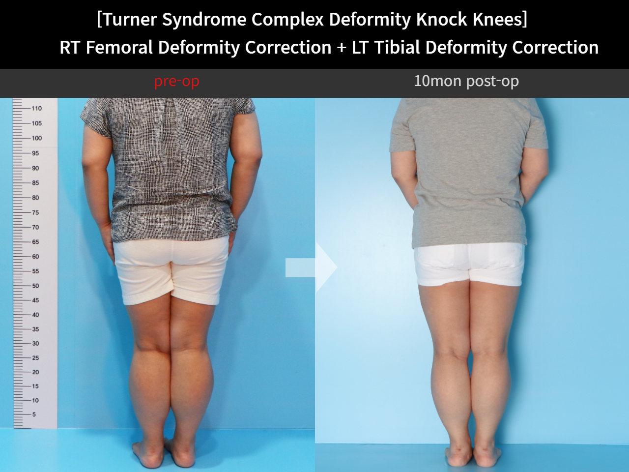 Before and after congenital condition, case 4640660, image 2, Dr. Donghoon institute (DALRI)