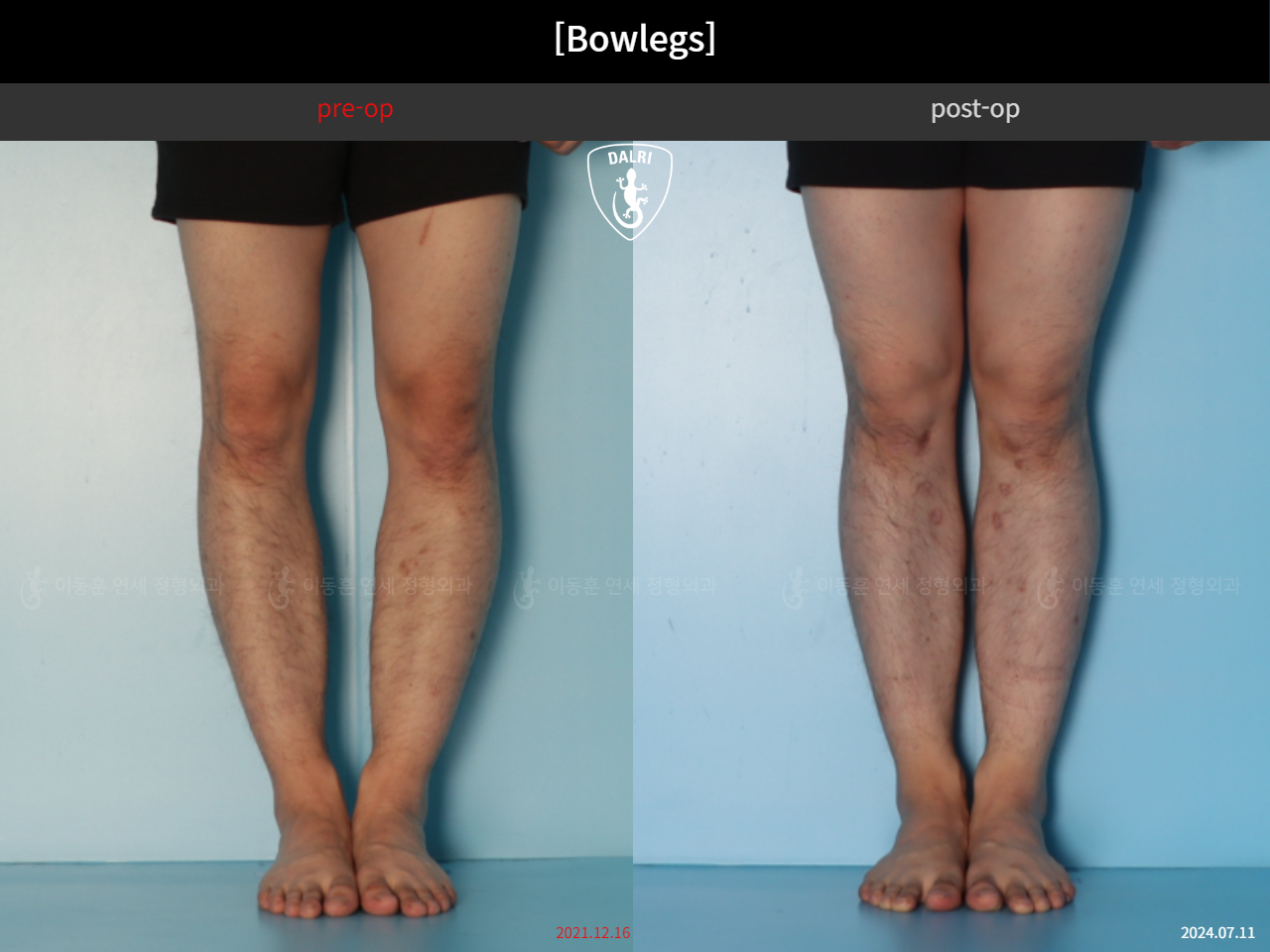 Before and after adult bowlegs, case 44111770, image 6, Dr. Donghoon institute (DALRI)