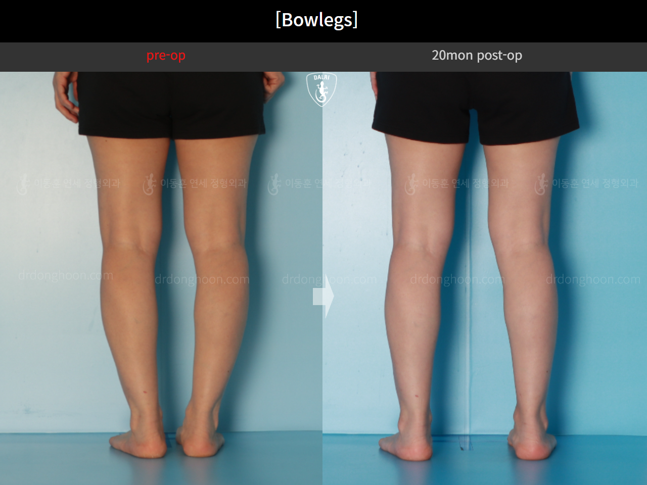 Before and after adult bowlegs, case 16724630, image 8, Dr. Donghoon institute (DALRI)