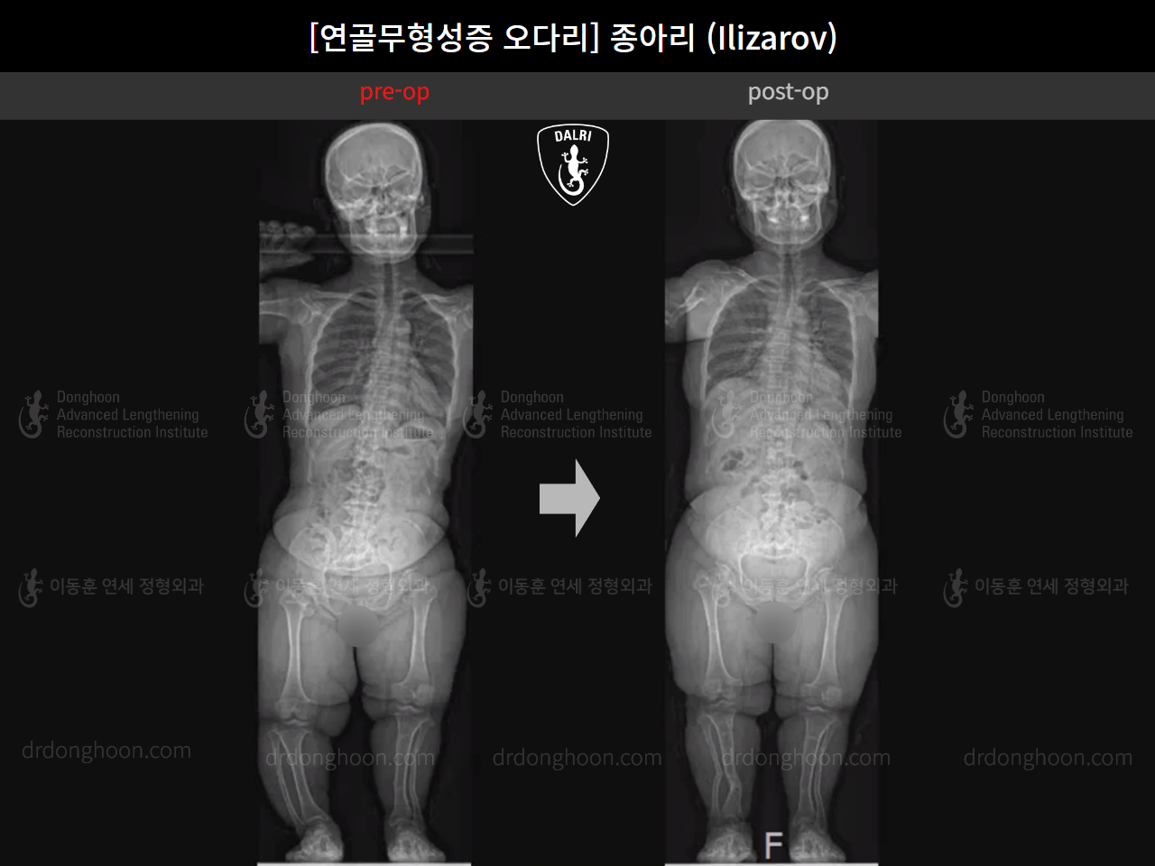 Before and after congenital condition, case 18077774, image 6, Dr. Donghoon institute (DALRI)