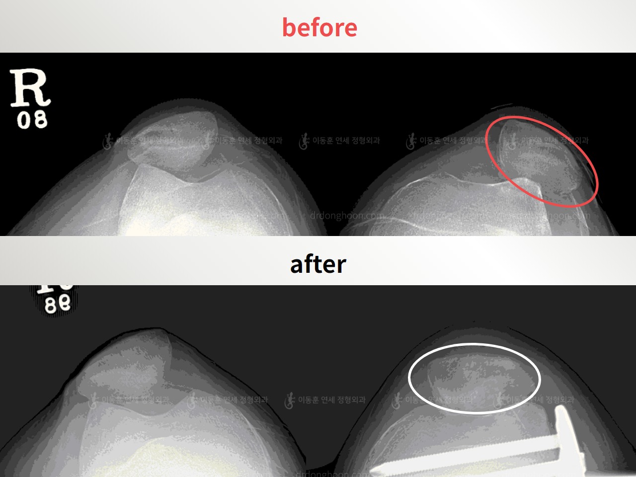 Before and after recurrent patella dislocation, case 4594069, image 1, Dr. Donghoon institute (DALRI)
