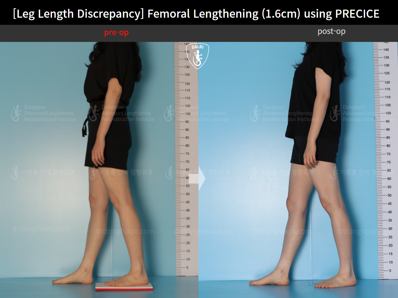 Before and after adult lld, case 15705968, image 4, Dr. Donghoon institute (DALRI)