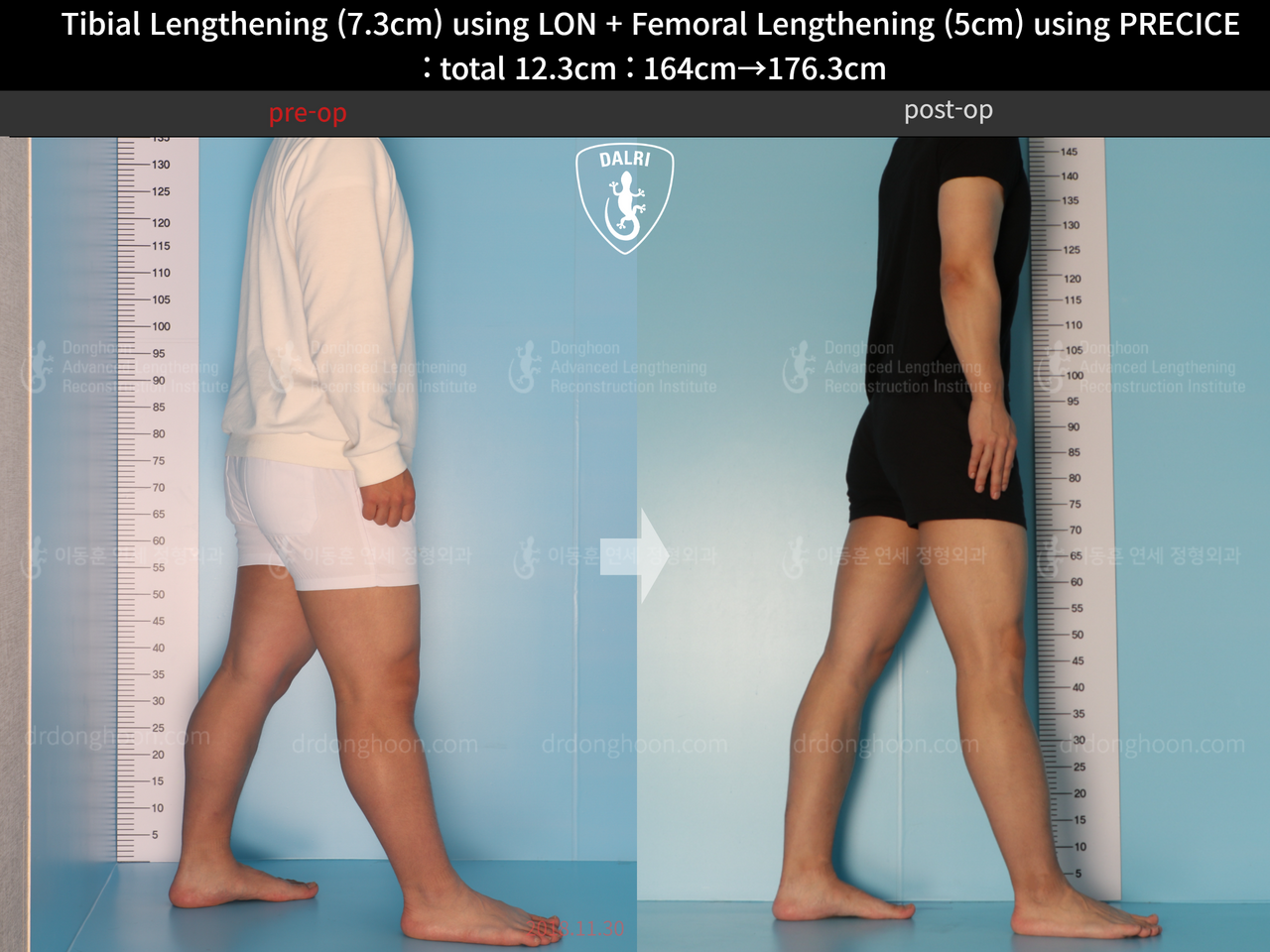 Before and after cll precice, case 13590455, image 4, Dr. Donghoon institute (DALRI)