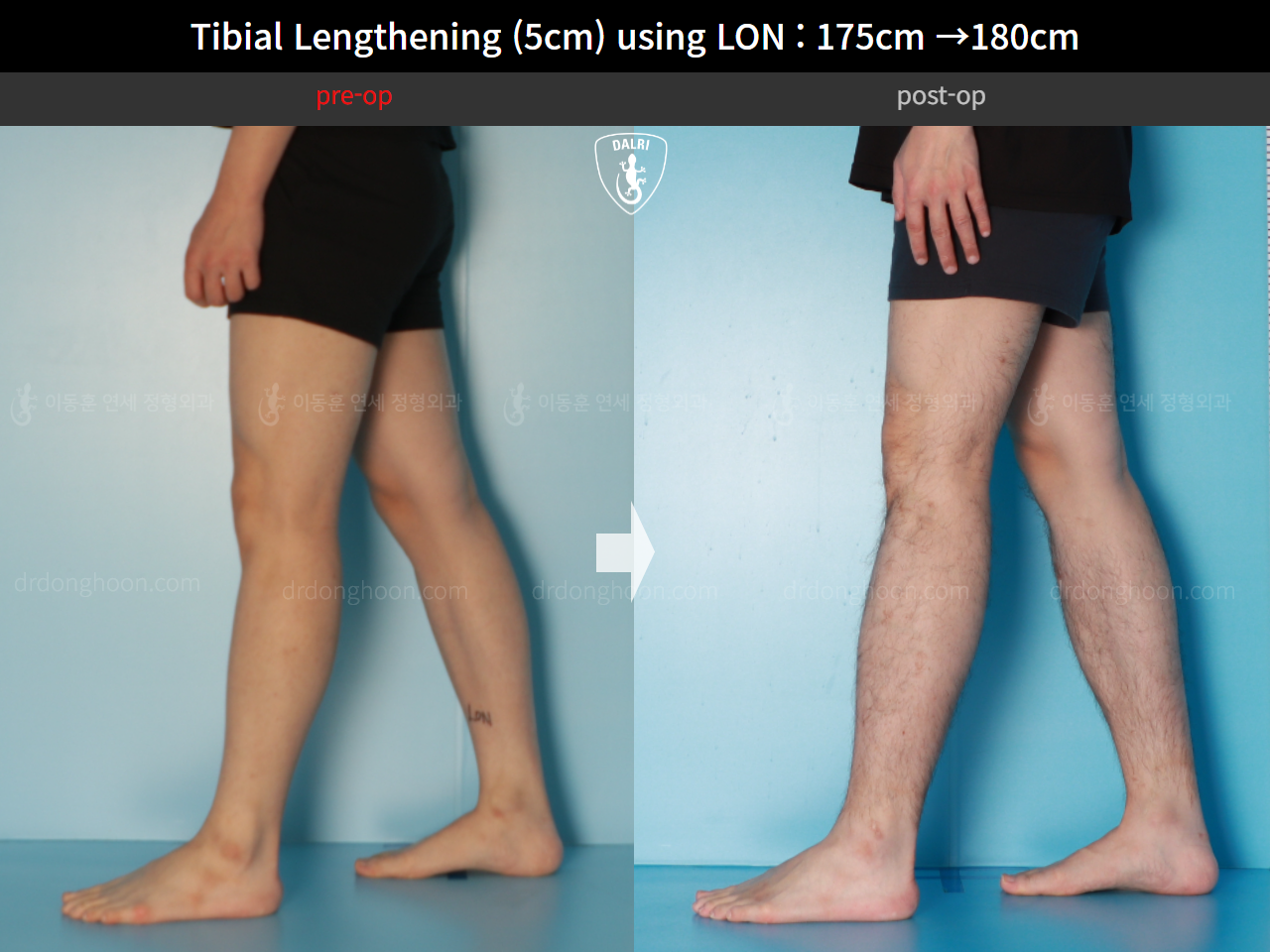 Before and after cll lon, case 15931051, image 8, Dr. Donghoon institute (DALRI)