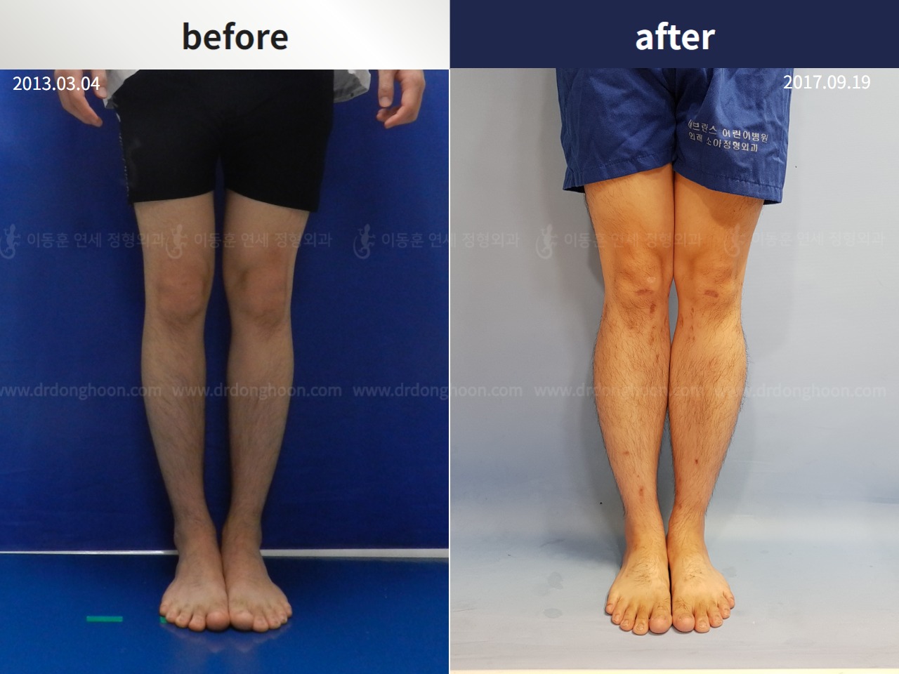 Before and after cll + deformity correction, case 4323099, image 1, Dr. Donghoon institute (DALRI)