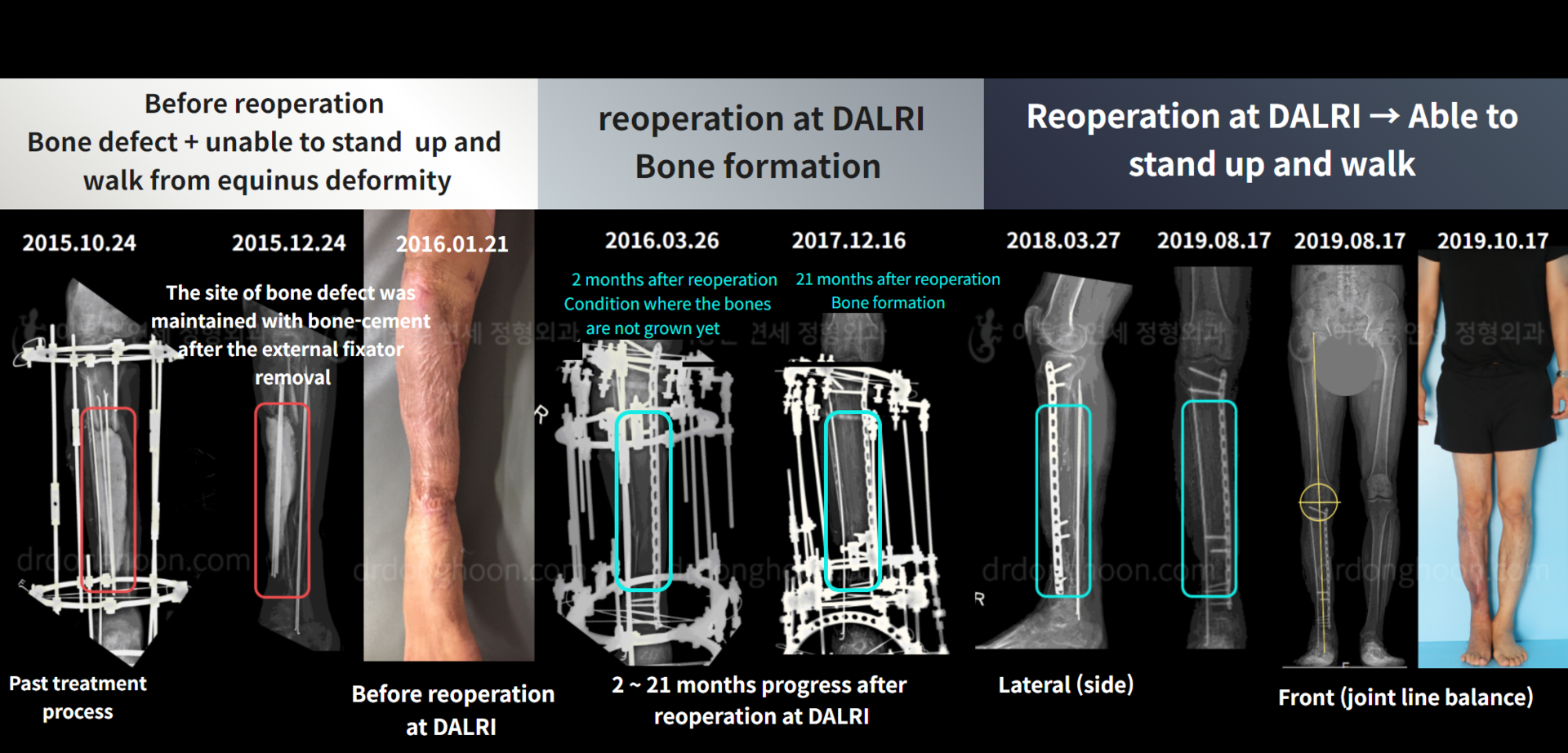 Before and after re-operation for cll, case 5200498, image 9, Dr. Donghoon institute (DALRI)