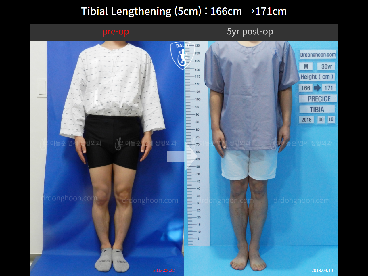 Before and after cll precice, case 4323361, image 1, Dr. Donghoon institute (DALRI)