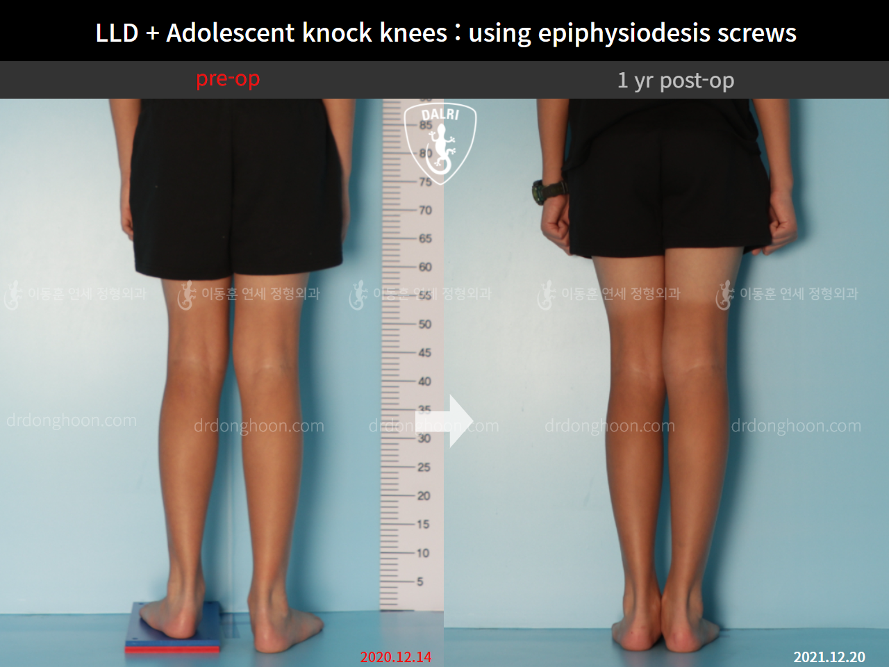 Before and after paediatric & adolescent knock knees, case 9186061, image 2, Dr. Donghoon institute (DALRI)