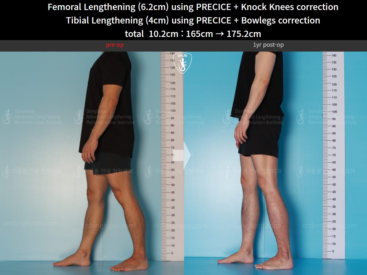 Before and after cll + deformity correction, case 15903252, image 7, Dr. Donghoon institute (DALRI)