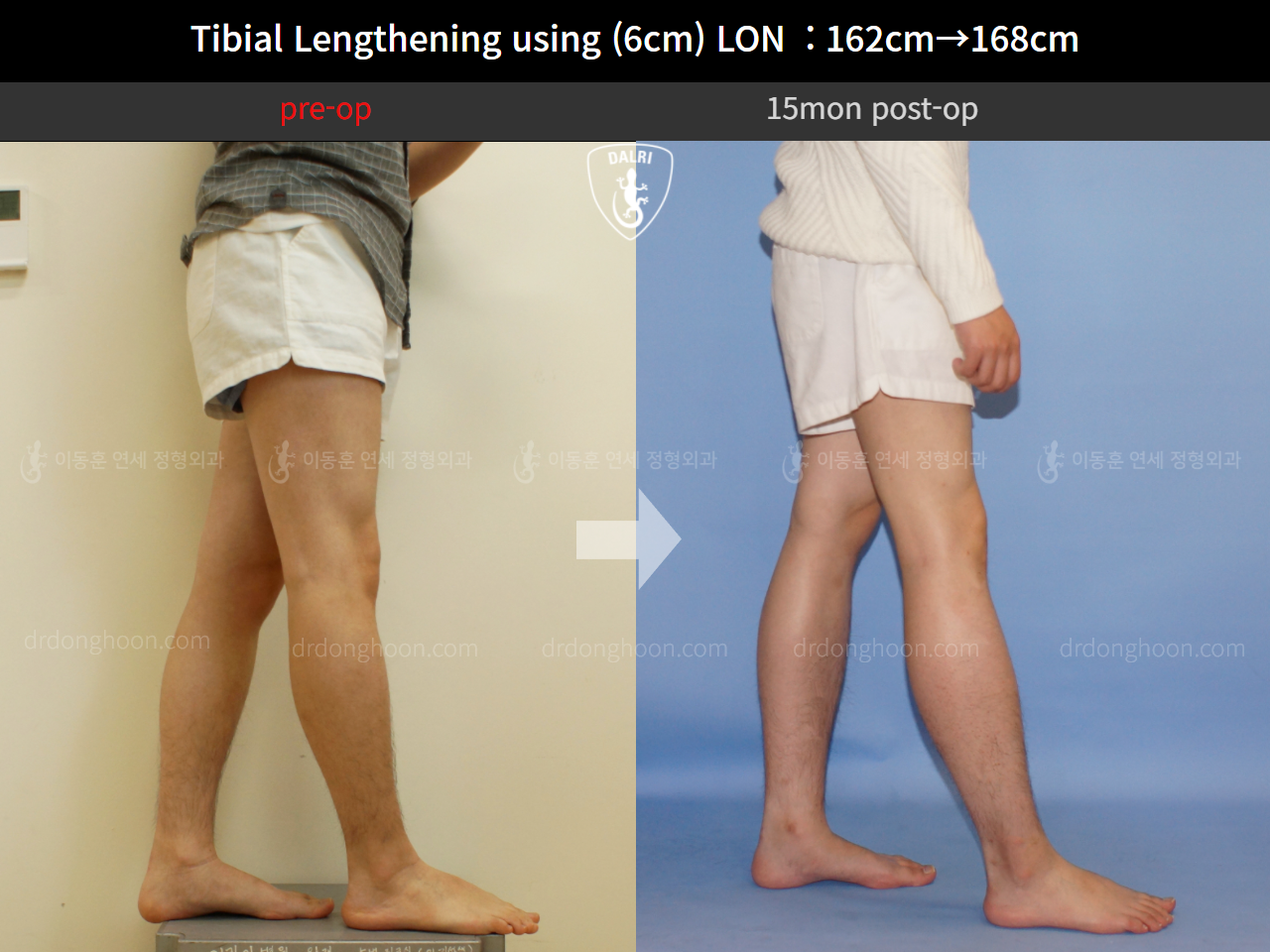 Before and after cll lon, case 4323473, image 4, Dr. Donghoon institute (DALRI)