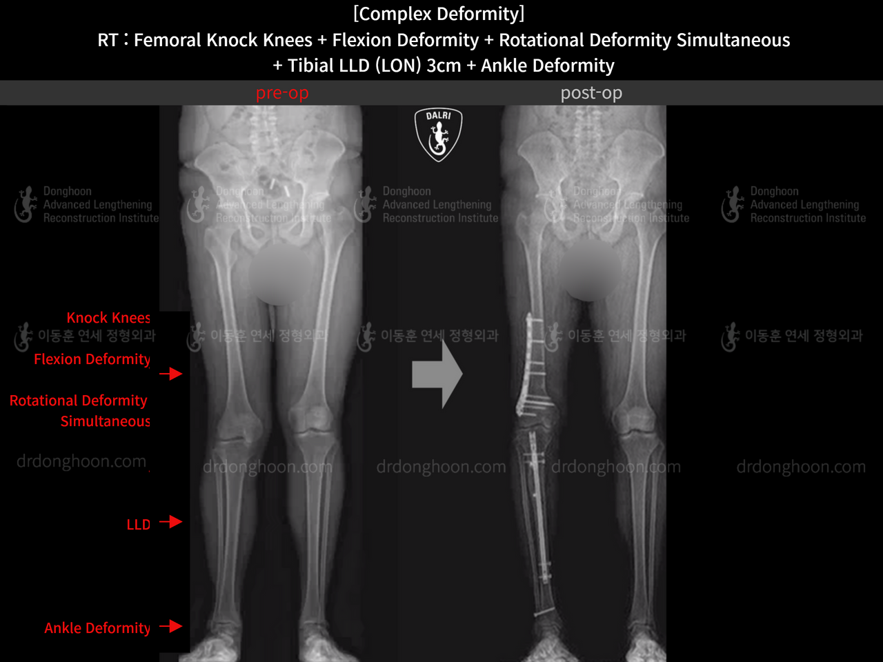 Before and after adult lld, case 14286604, image 8, Dr. Donghoon institute (DALRI)