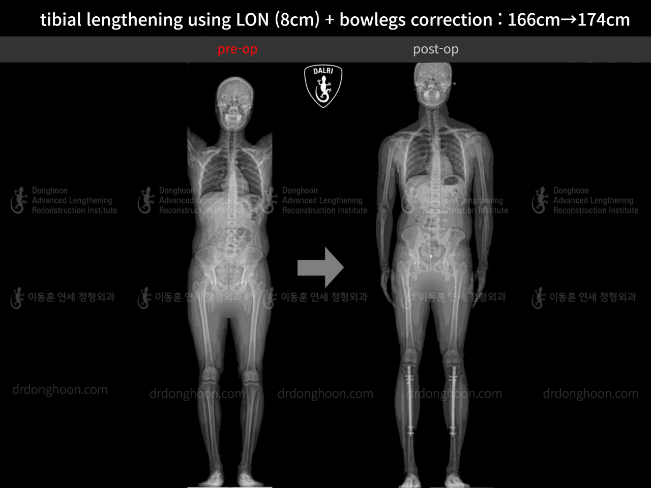 Before and after cll + deformity correction, case 13418165, image 1, Dr. Donghoon institute (DALRI)