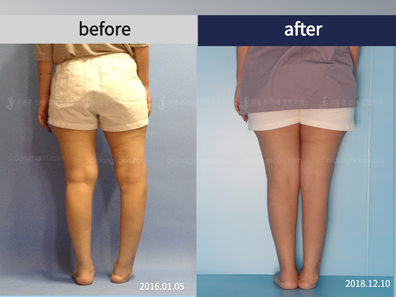 Before and after adult lld, case 4520633, image 3, Dr. Donghoon institute (DALRI)