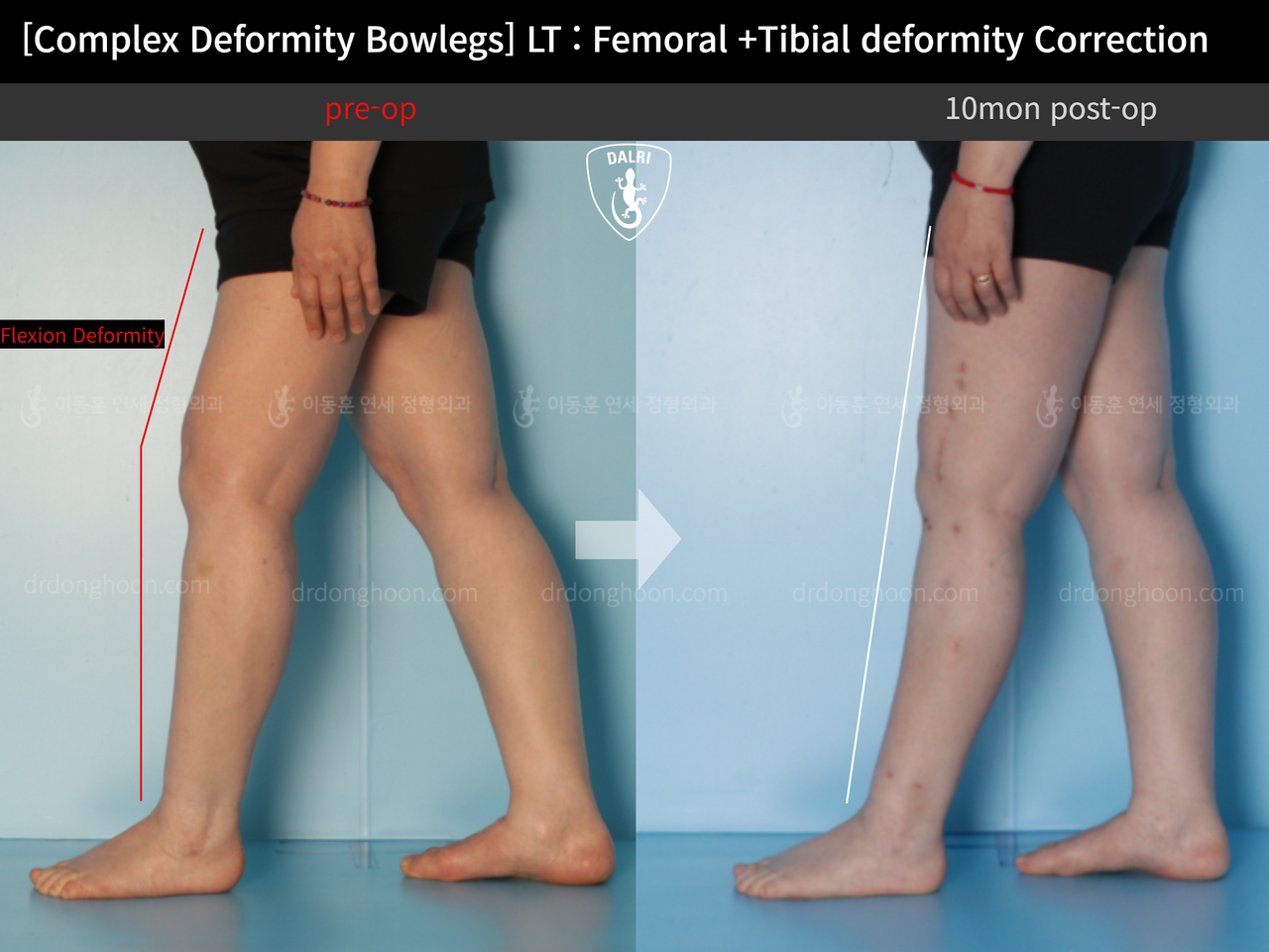 Before and after adult bowlegs, case 12790433, image 6, Dr. Donghoon institute (DALRI)