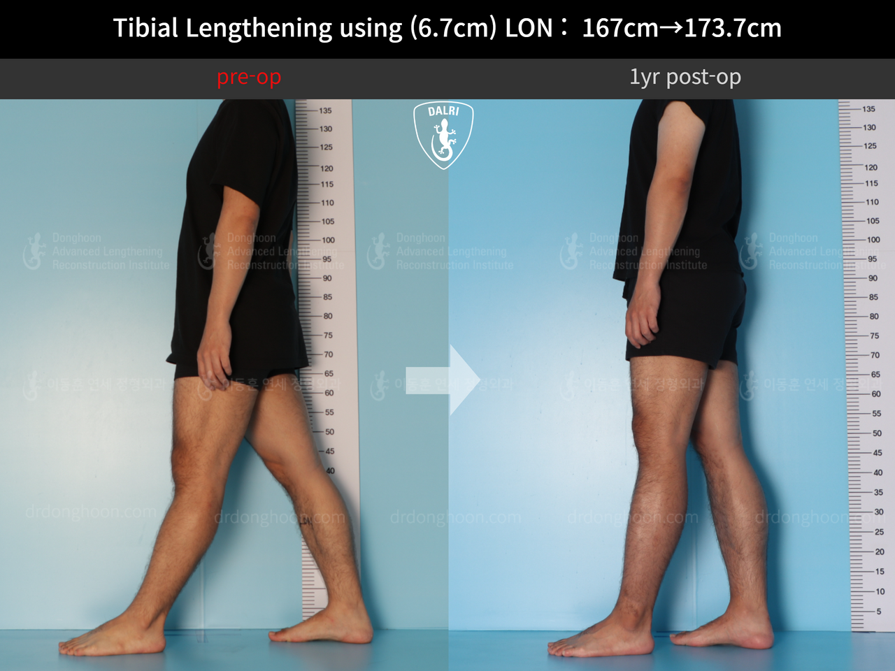 Before and after cll lon, case 12426969, image 4, Dr. Donghoon institute (DALRI)