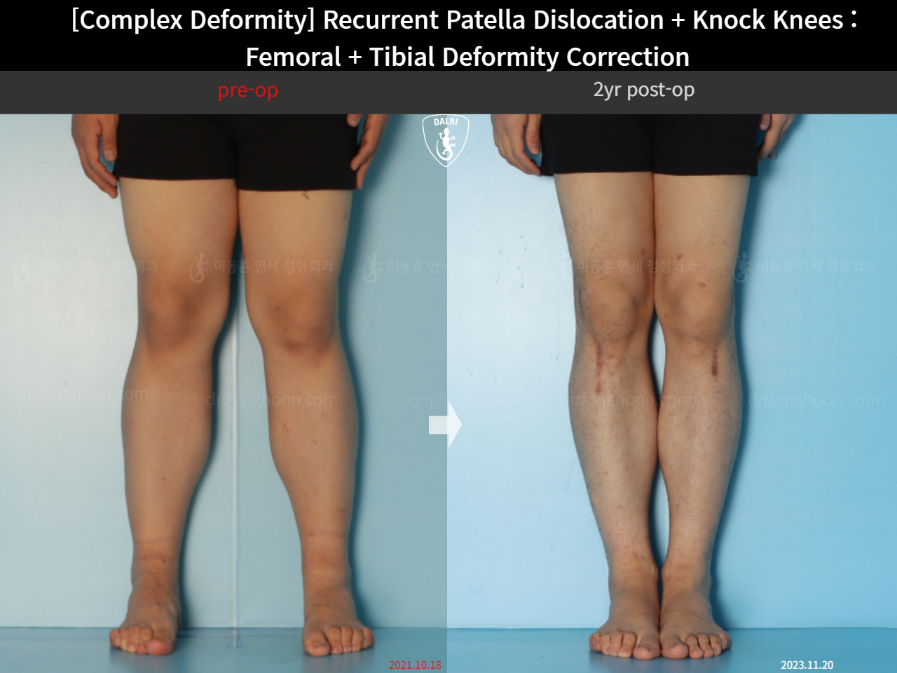 Before and after adult knock knees, case 17434917, image 5, Dr. Donghoon institute (DALRI)