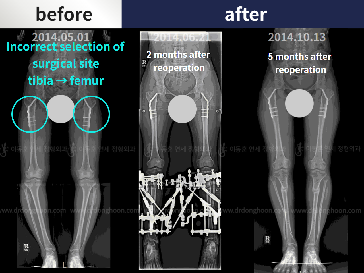 Before and after adult bowlegs, case 4764706, image 3, Dr. Donghoon institute (DALRI)
