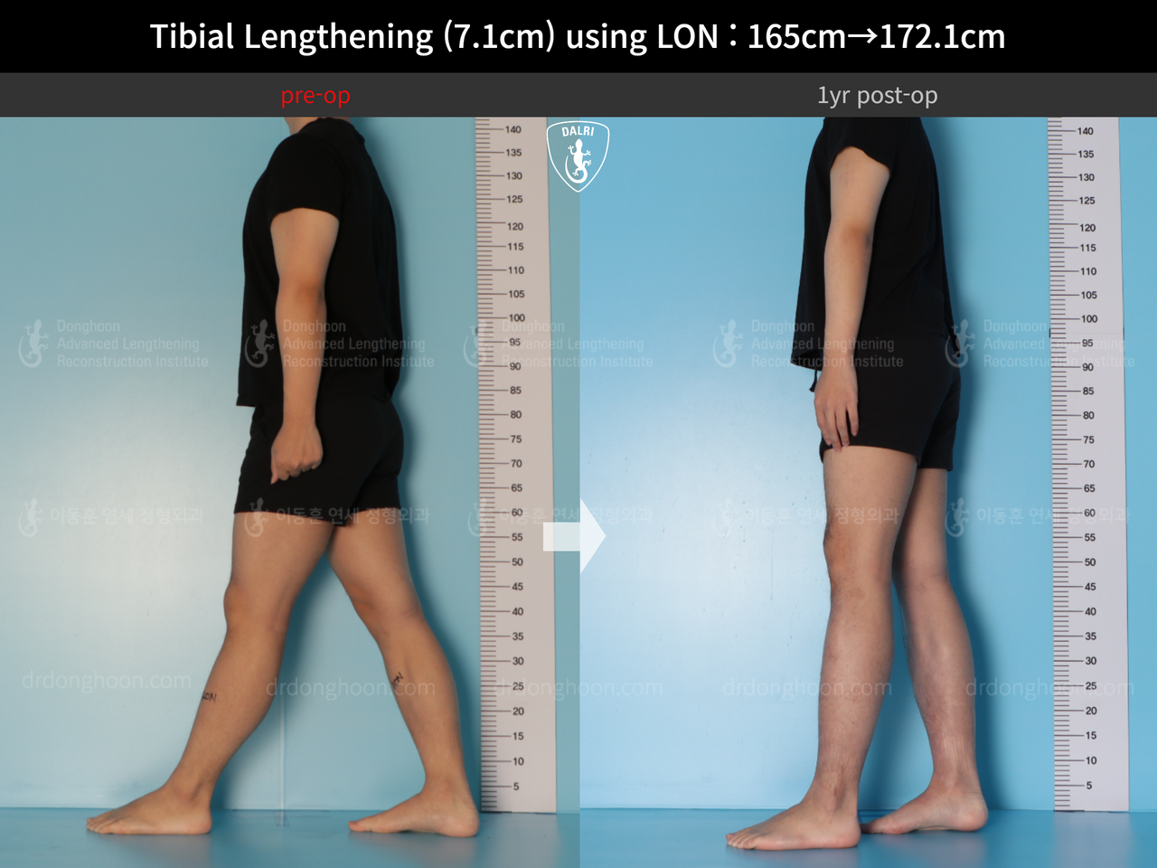 Before and after cll lon, case 14318674, image 5, Dr. Donghoon institute (DALRI)