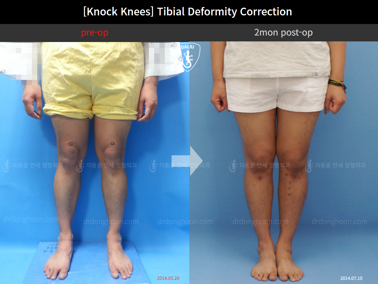 Before and after adult knock knees, case 4310814, image 1, Dr. Donghoon institute (DALRI)