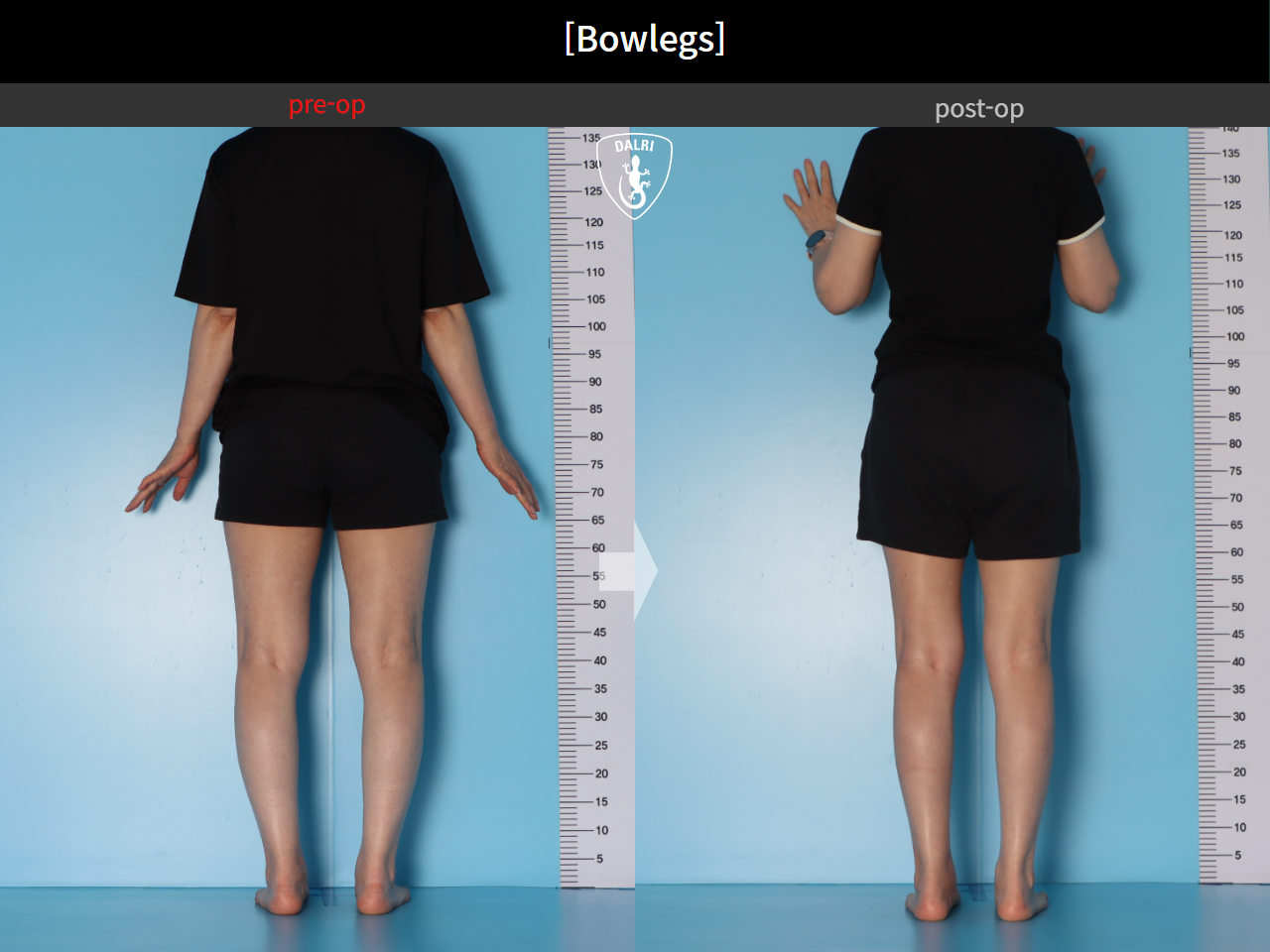 Before and after adult bowlegs, case 30256399, image 5, Dr. Donghoon institute (DALRI)
