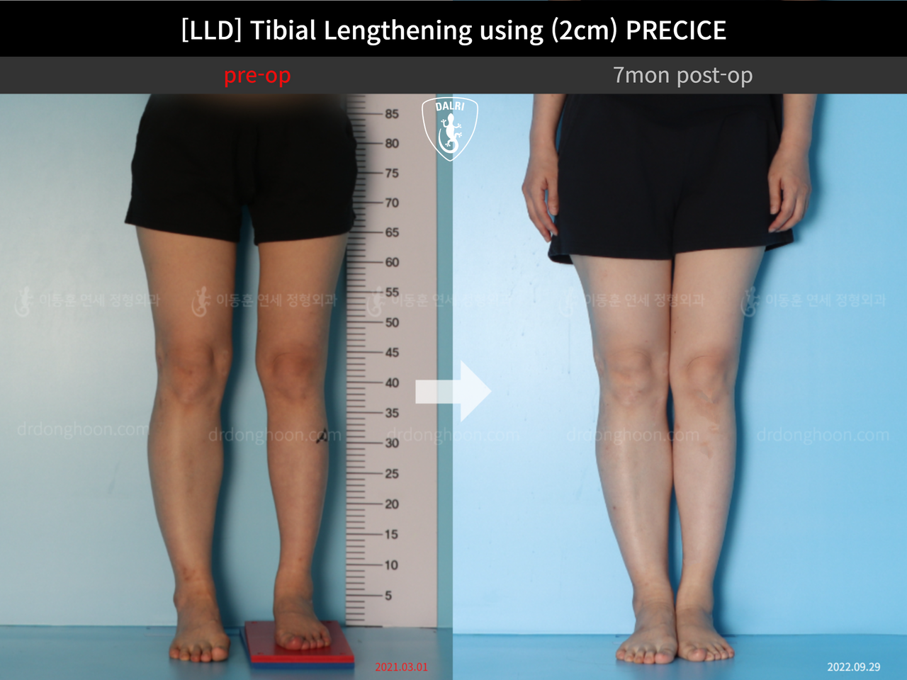 Before and after adult lld, case 12985023, image 5, Dr. Donghoon institute (DALRI)