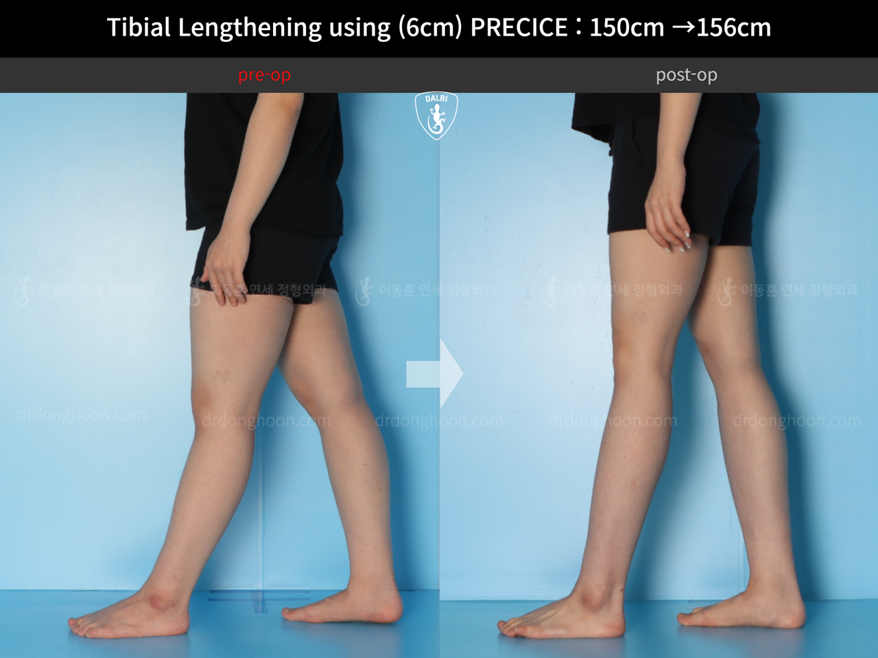 Before and after cll precice, case 14065180, image 8, Dr. Donghoon institute (DALRI)