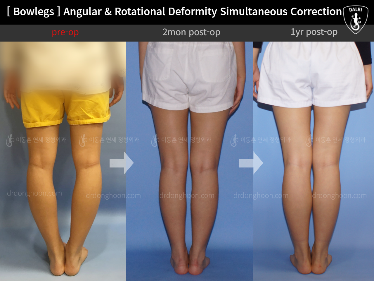 Before and after adult bowlegs, case 9036639, image 4, Dr. Donghoon institute (DALRI)
