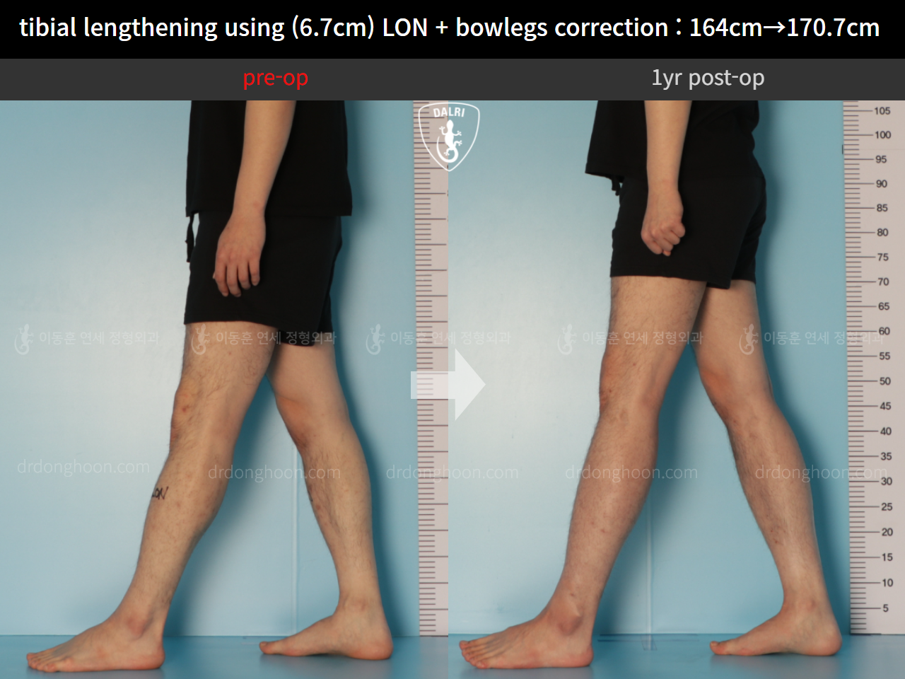 Before and after cll + deformity correction, case 11037343, image 8, Dr. Donghoon institute (DALRI)