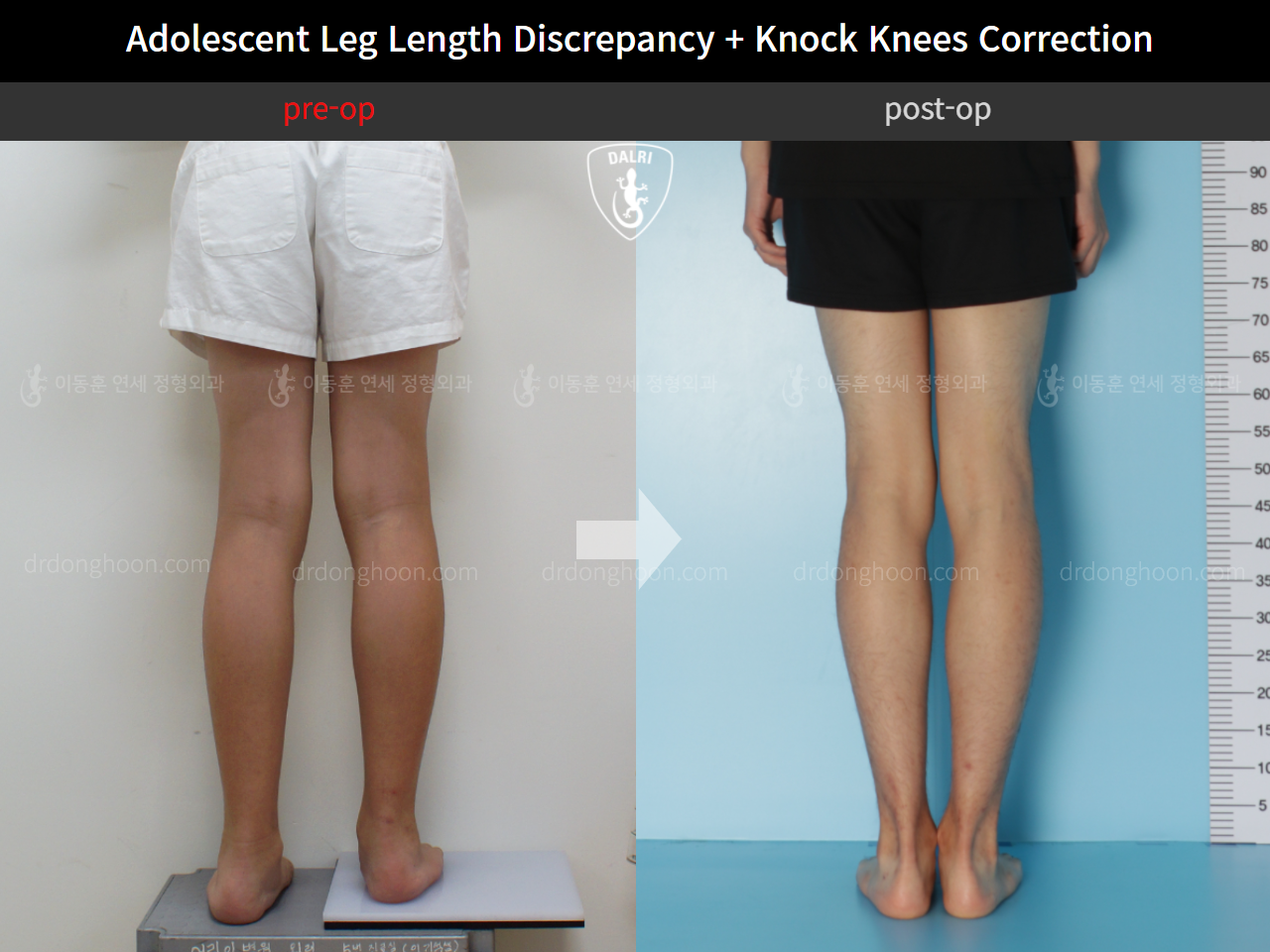 Before and after paediatric & adolescent lld, case 4585692, image 4, Dr. Donghoon institute (DALRI)