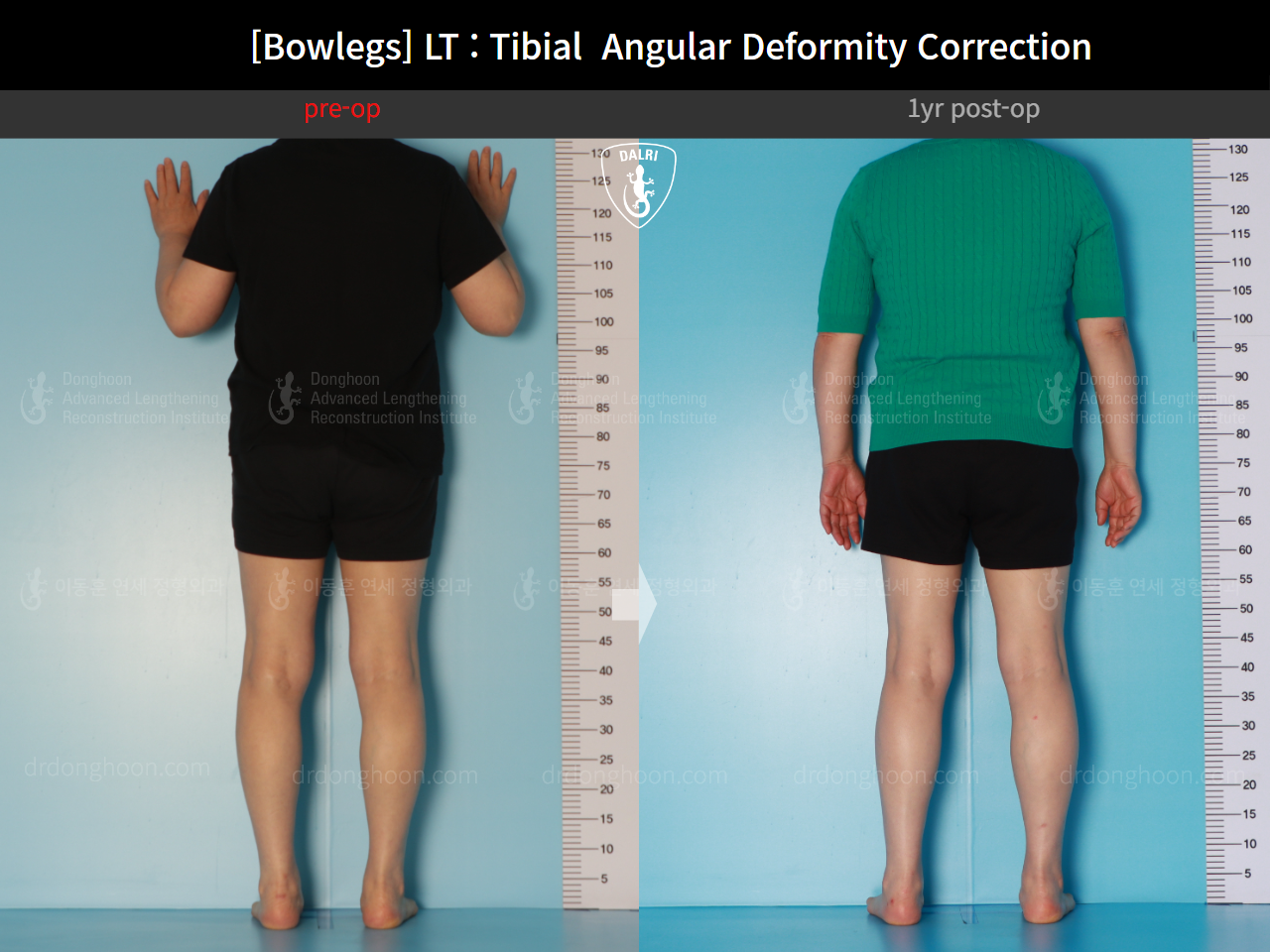 Before and after adult bowlegs, case 16787003, image 4, Dr. Donghoon institute (DALRI)