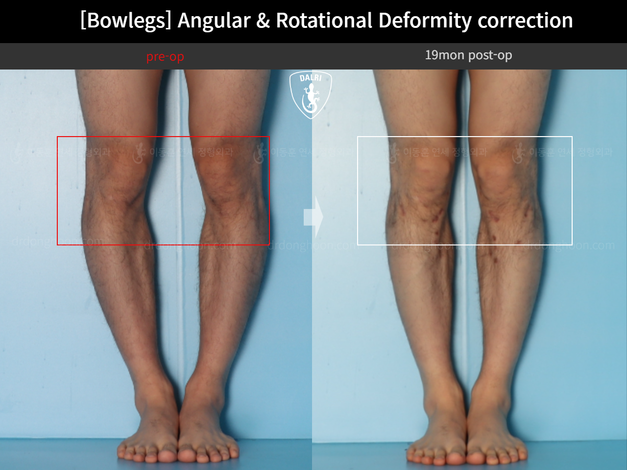 Before and after adult bowlegs, case 18306379, image 9, Dr. Donghoon institute (DALRI)