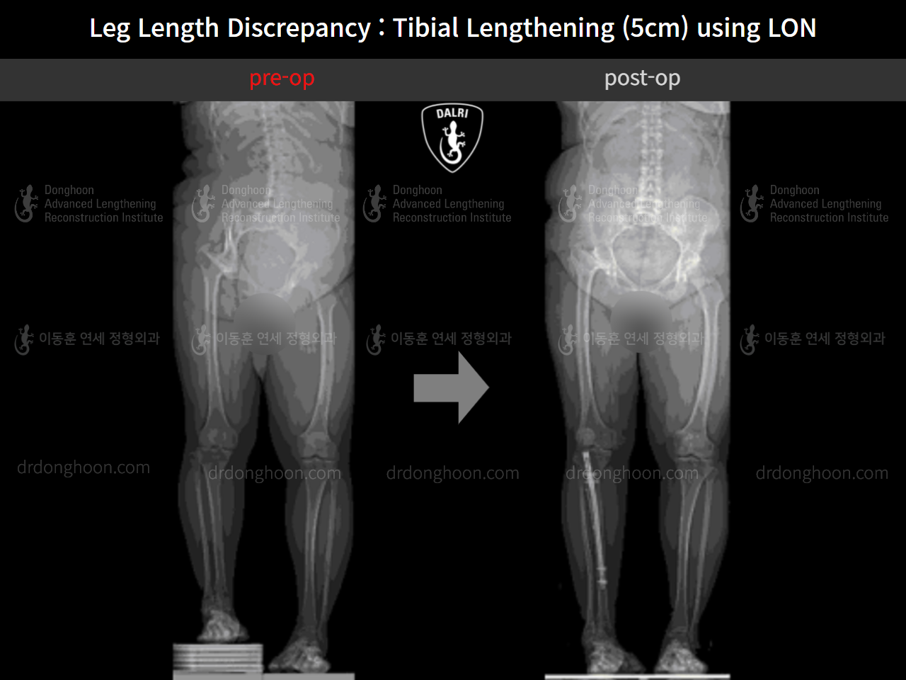 Before and after adult lld, case 9974673, image 8, Dr. Donghoon institute (DALRI)