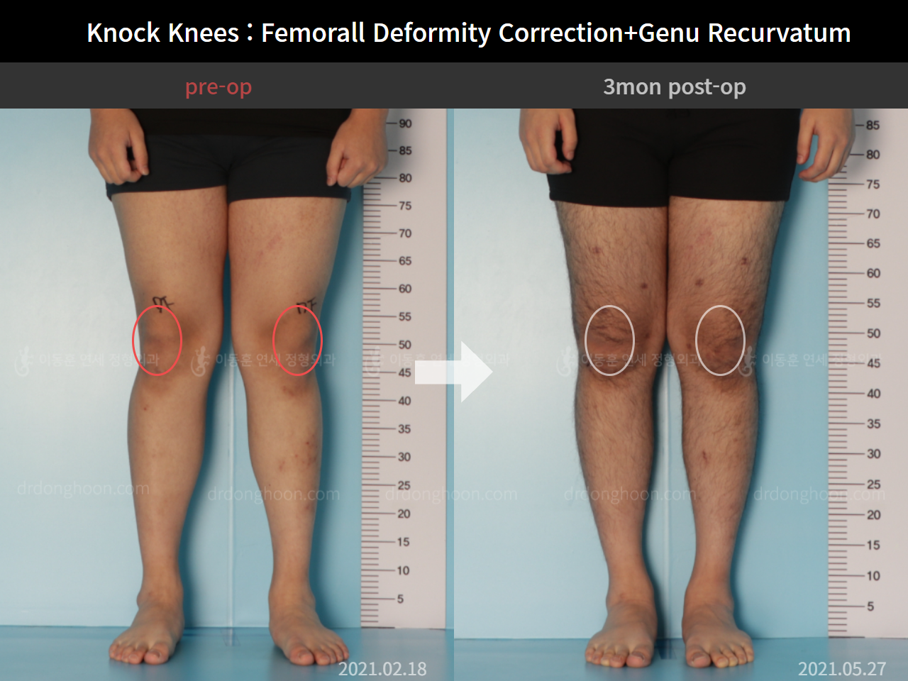Before and after adult knock knees, case 7165631, image 3, Dr. Donghoon institute (DALRI)
